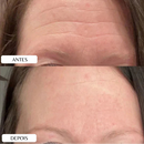 New Botox Skin Lift – Adesivo Anti Rugas Reutilizável para Linhas de Expressão
